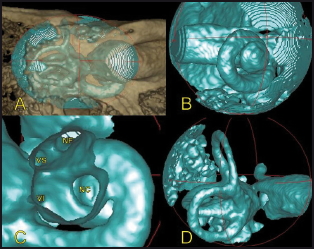 Reconstrucciones volumétricas de hueso temporal mediante Cone Beam (CBCT)