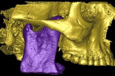 Articulación Temporo Mandibular (ATM)